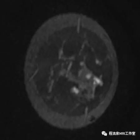 怎样理解BI-RADS 4类病灶 怎样理解BI-RADS 4类病灶