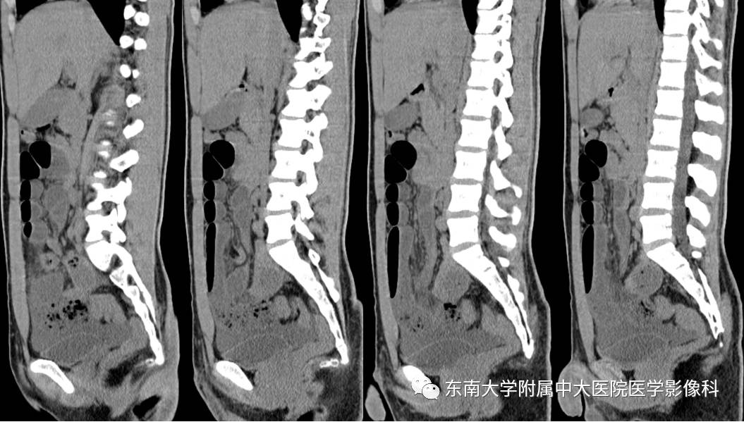 【病例】Meckel憩室伴小肠系膜相关型疝1例