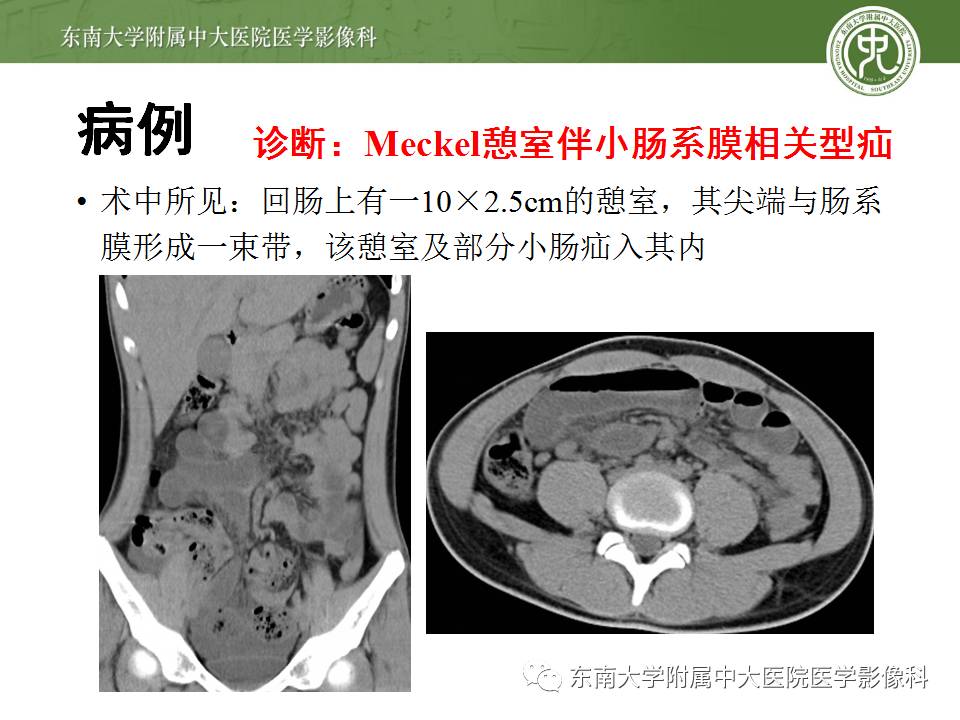【病例】Meckel憩室伴小肠系膜相关型疝1例