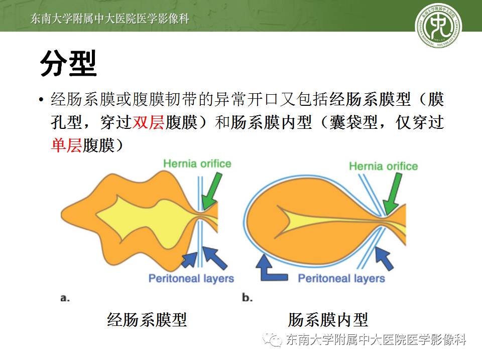 【病例】Meckel憩室伴小肠系膜相关型疝1例
