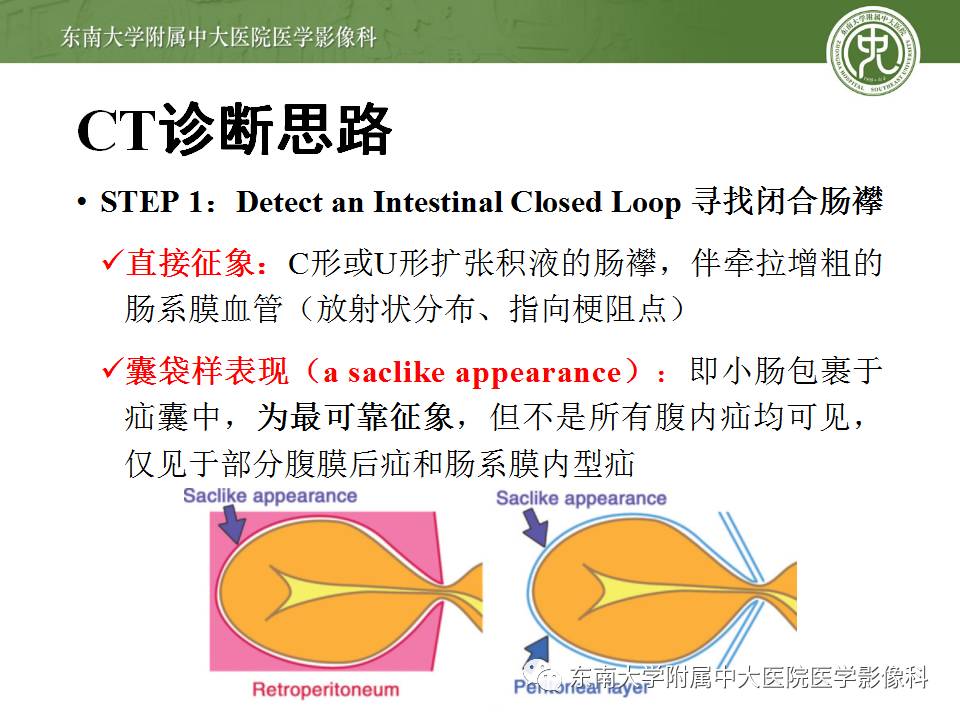 【病例】Meckel憩室伴小肠系膜相关型疝1例
