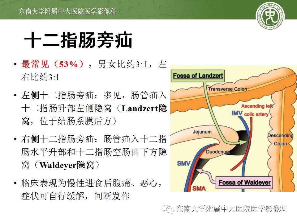 【病例】Meckel憩室伴小肠系膜相关型疝1例