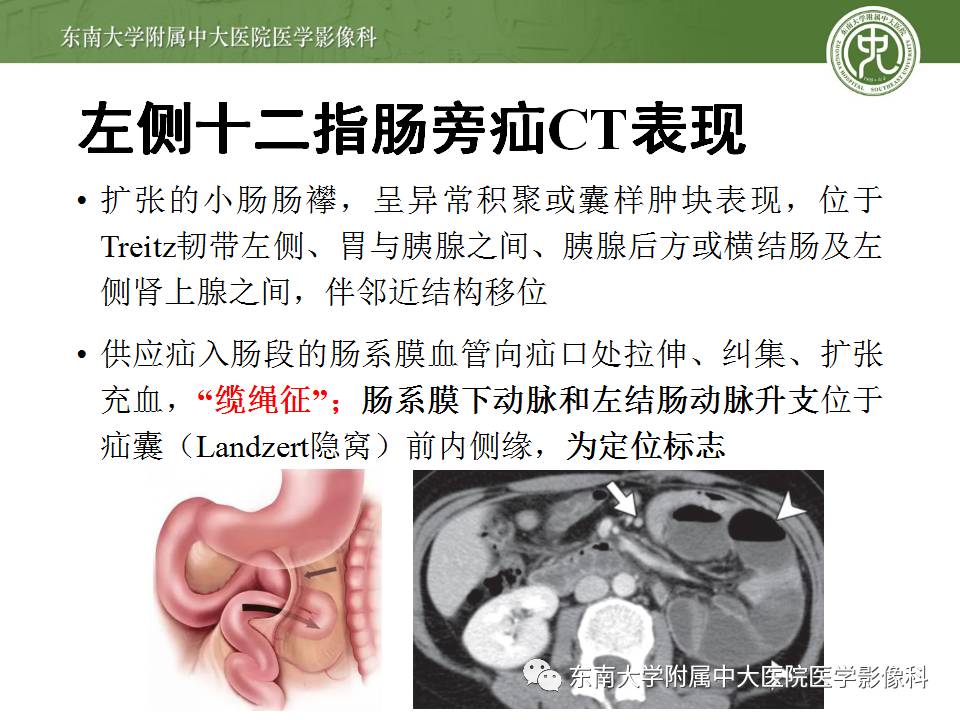 【病例】Meckel憩室伴小肠系膜相关型疝1例