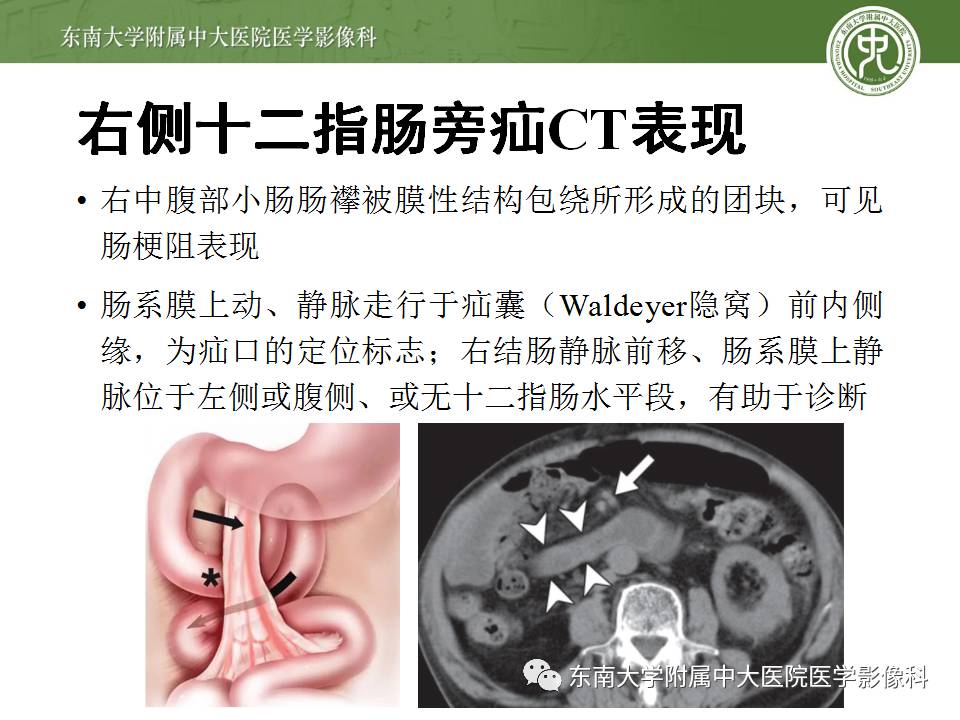 【病例】Meckel憩室伴小肠系膜相关型疝1例