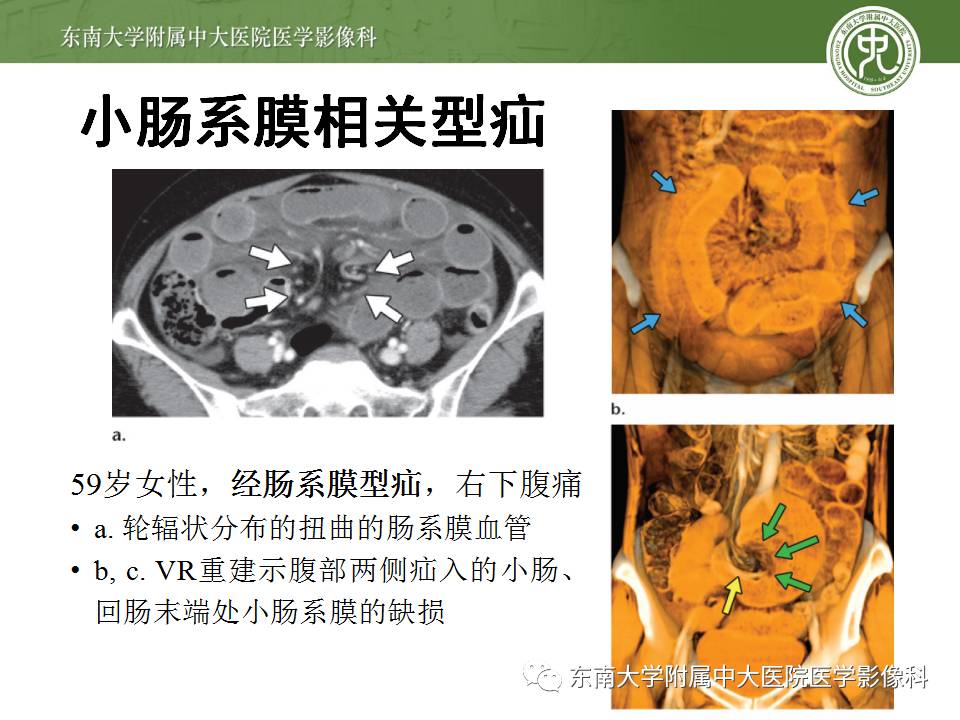 【病例】Meckel憩室伴小肠系膜相关型疝1例