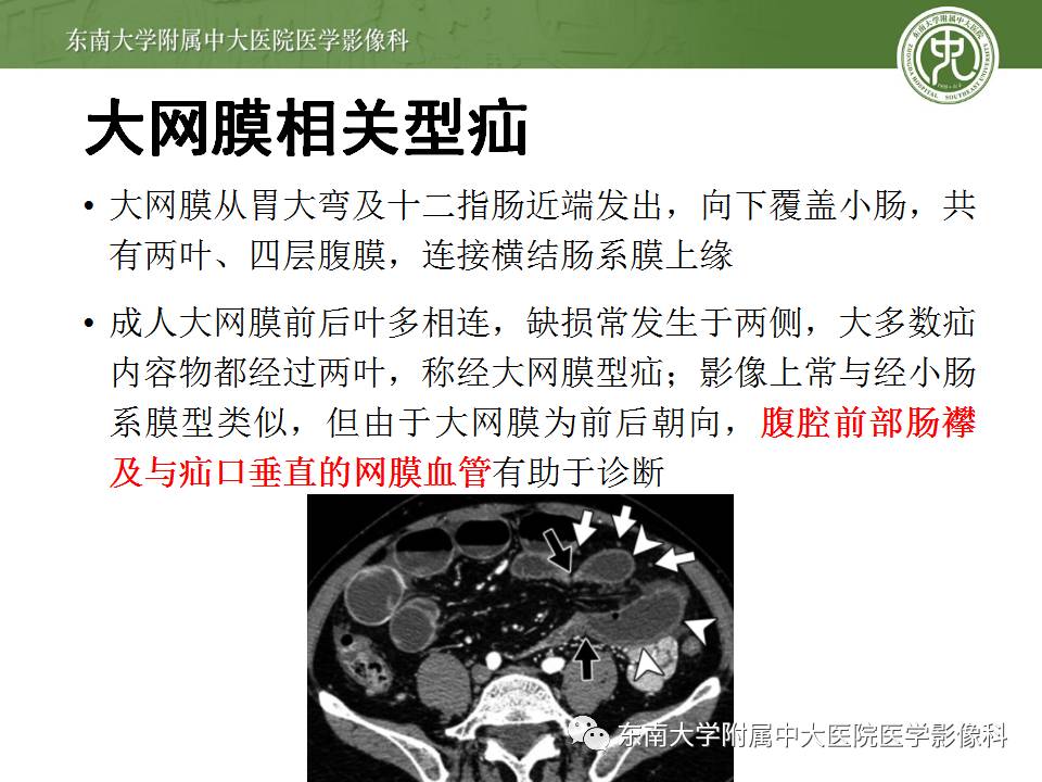 【病例】Meckel憩室伴小肠系膜相关型疝1例