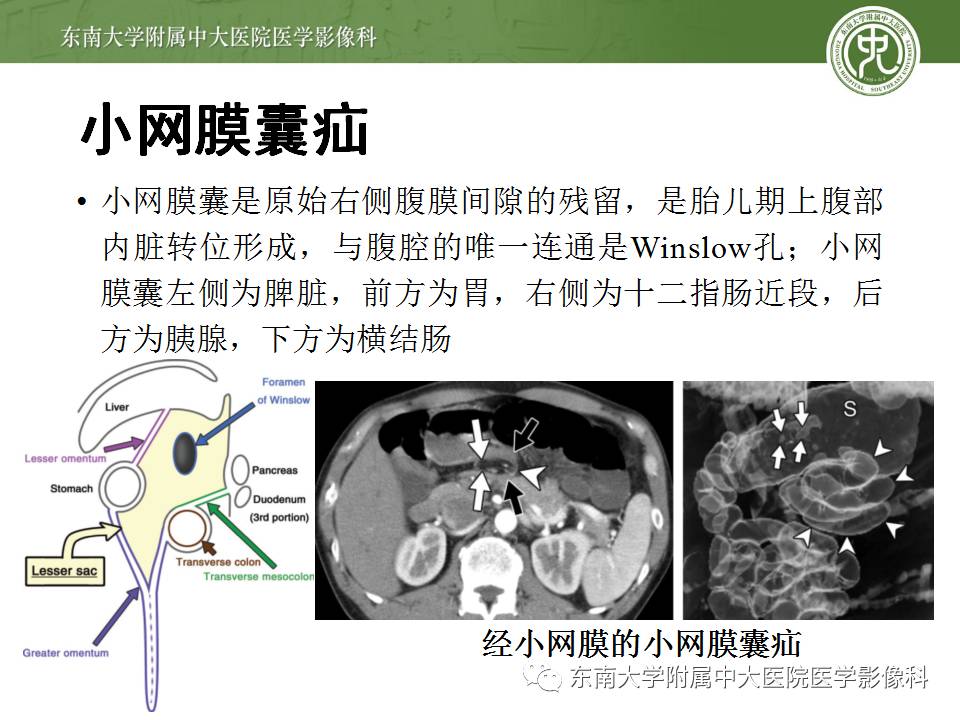 【病例】Meckel憩室伴小肠系膜相关型疝1例