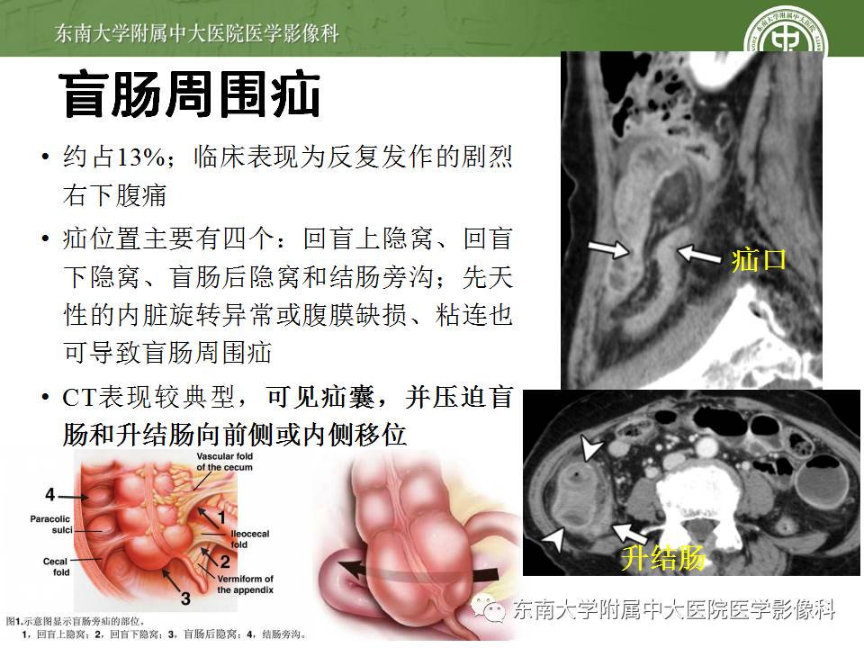 【病例】Meckel憩室伴小肠系膜相关型疝1例