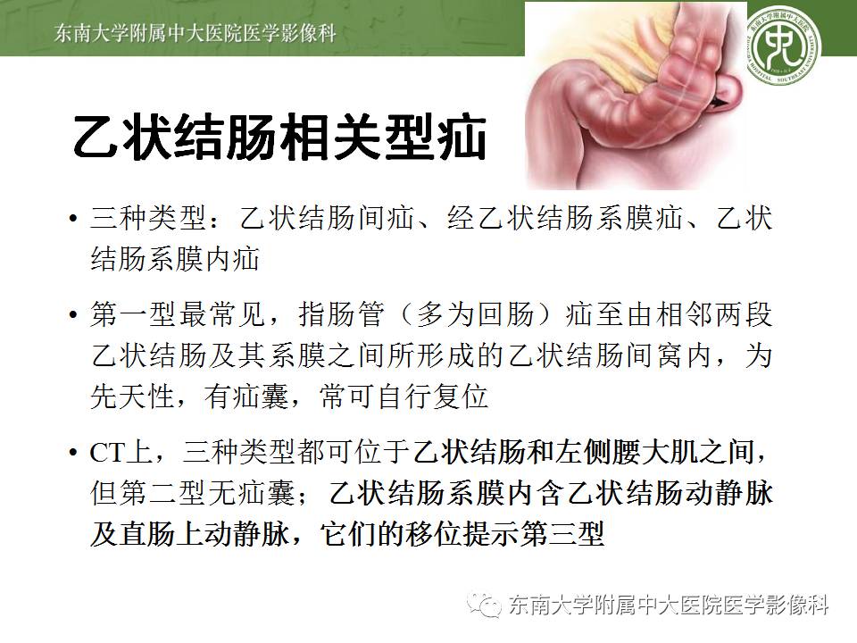 【病例】Meckel憩室伴小肠系膜相关型疝1例