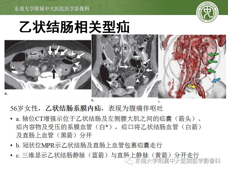 【病例】Meckel憩室伴小肠系膜相关型疝1例