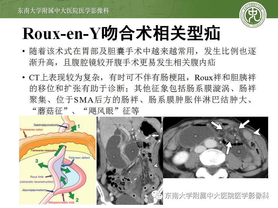 【病例】Meckel憩室伴小肠系膜相关型疝1例