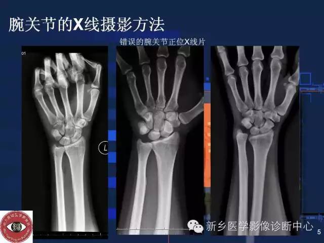 详细的腕关节X线解剖+摄影技巧+阅片技巧+测量 详细的腕关节X线解剖+摄影技巧+阅片技巧+测量