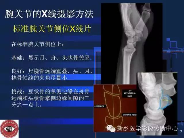 详细的腕关节X线解剖+摄影技巧+阅片技巧+测量 详细的腕关节X线解剖+摄影技巧+阅片技巧+测量