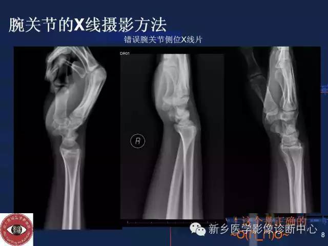 详细的腕关节X线解剖+摄影技巧+阅片技巧+测量 详细的腕关节X线解剖+摄影技巧+阅片技巧+测量
