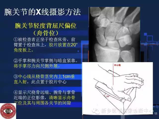 详细的腕关节X线解剖+摄影技巧+阅片技巧+测量 详细的腕关节X线解剖+摄影技巧+阅片技巧+测量
