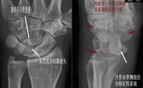 详细的腕关节X线解剖+摄影技巧+阅片技巧+测量 详细的腕关节X线解剖+摄影技巧+阅片技巧+测量