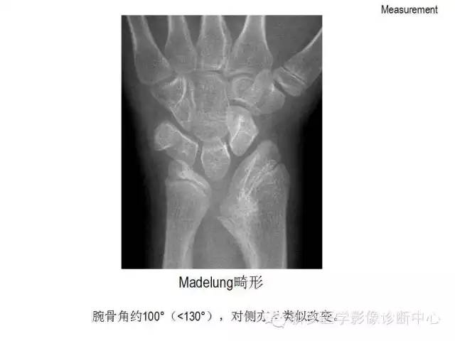 详细的腕关节X线解剖+摄影技巧+阅片技巧+测量 详细的腕关节X线解剖+摄影技巧+阅片技巧+测量