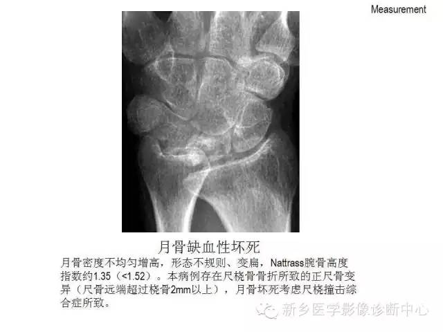 详细的腕关节X线解剖+摄影技巧+阅片技巧+测量 详细的腕关节X线解剖+摄影技巧+阅片技巧+测量