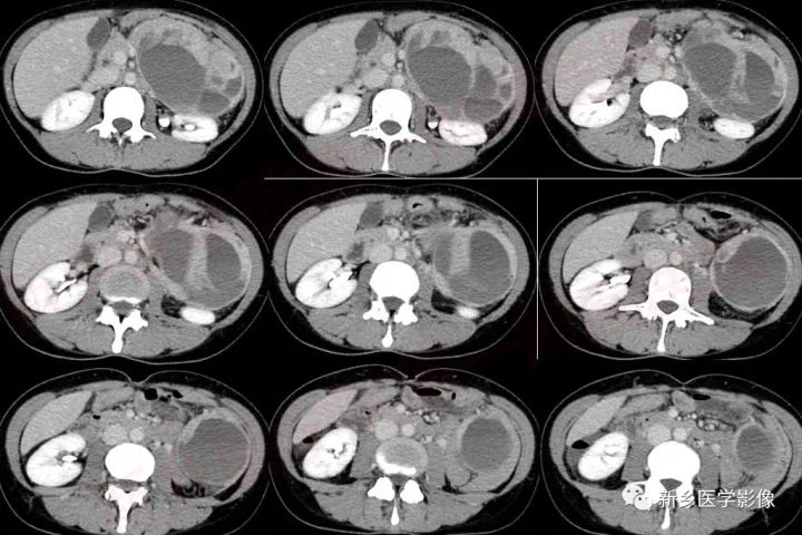 【病例】腹膜后胃肠道外间质瘤1例CT影像表现 【病例】腹膜后胃肠道外间质瘤1例CT影像表现