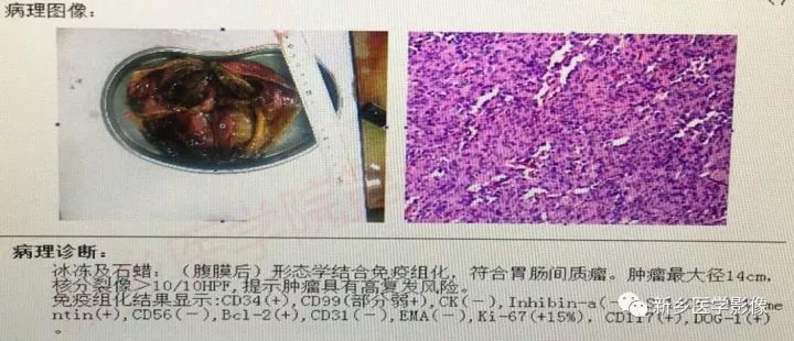 【病例】腹膜后胃肠道外间质瘤1例CT影像表现 【病例】腹膜后胃肠道外间质瘤1例CT影像表现