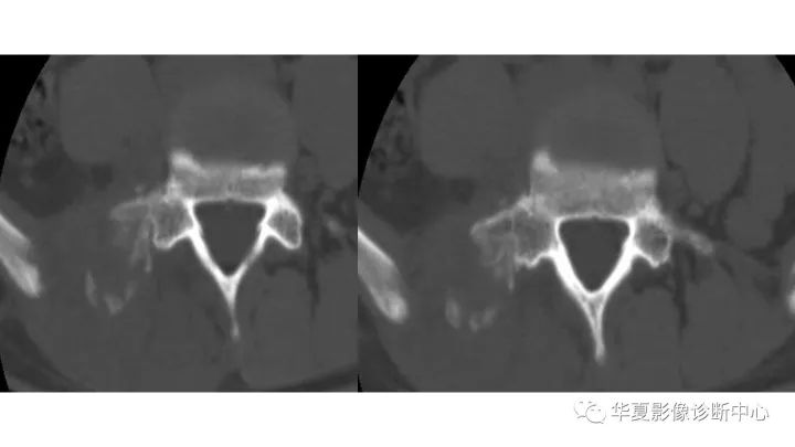 【病例】腰椎横突旁骨化性肌炎1例CT及MR影像表现