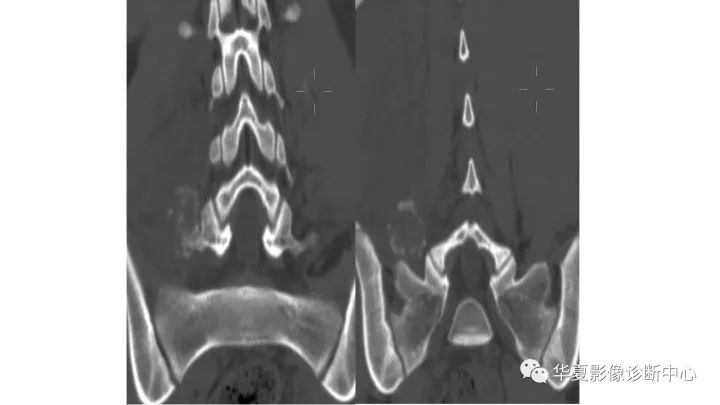【病例】腰椎横突旁骨化性肌炎1例CT及MR影像表现