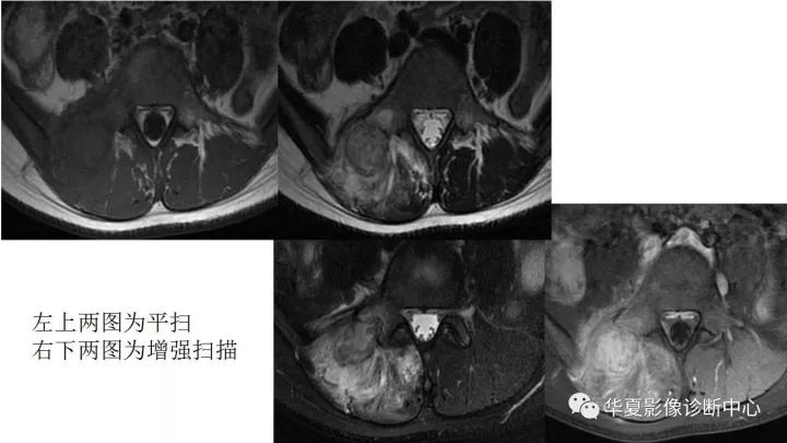 【病例】腰椎横突旁骨化性肌炎1例CT及MR影像表现
