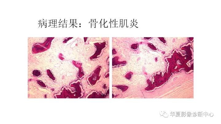 【病例】腰椎横突旁骨化性肌炎1例CT及MR影像表现