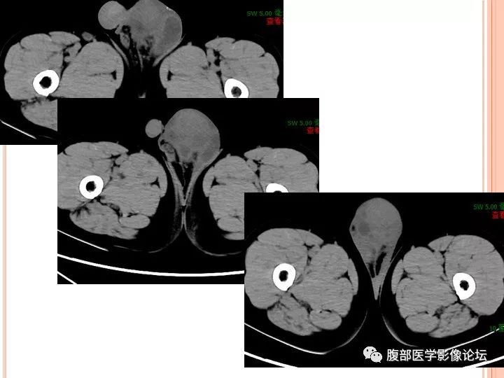 【病例】睾丸结核1例CT影像表现 【病例】睾丸结核1例CT影像表现