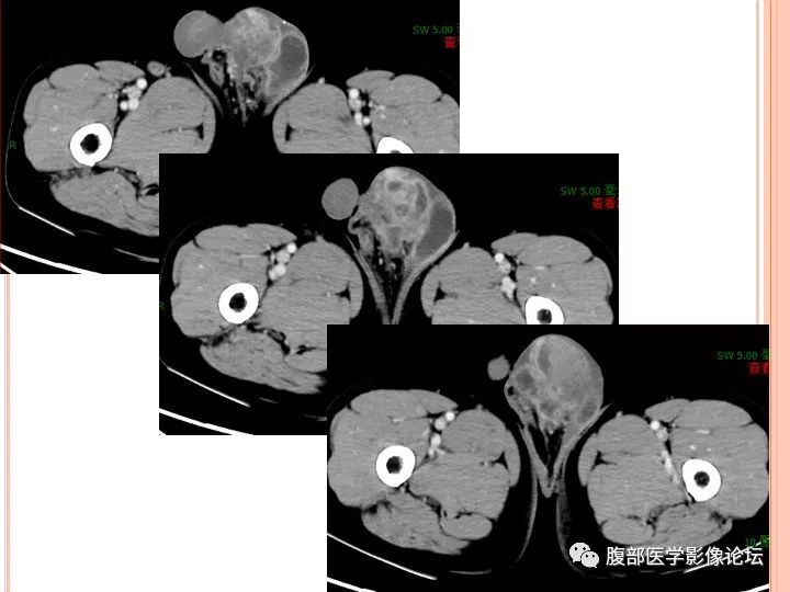 【病例】睾丸结核1例CT影像表现 【病例】睾丸结核1例CT影像表现