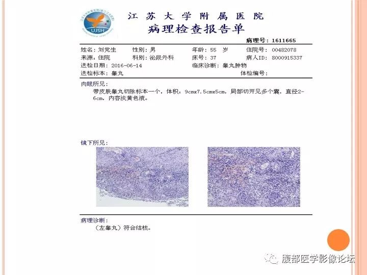 【病例】睾丸结核1例CT影像表现 【病例】睾丸结核1例CT影像表现