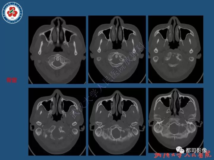 【病例】寰椎及枕骨弥漫性腱鞘巨细胞瘤1例CT及MR影像诊断