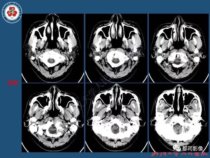 【病例】寰椎及枕骨弥漫性腱鞘巨细胞瘤1例CT及MR影像诊断