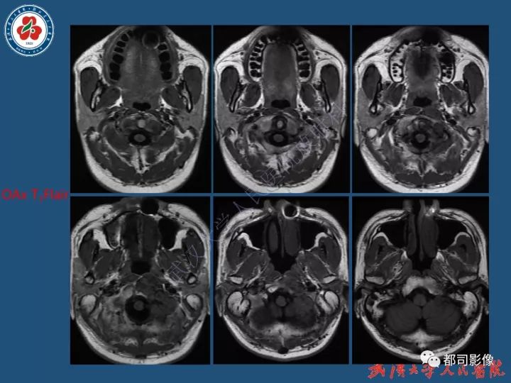 【病例】寰椎及枕骨弥漫性腱鞘巨细胞瘤1例CT及MR影像诊断