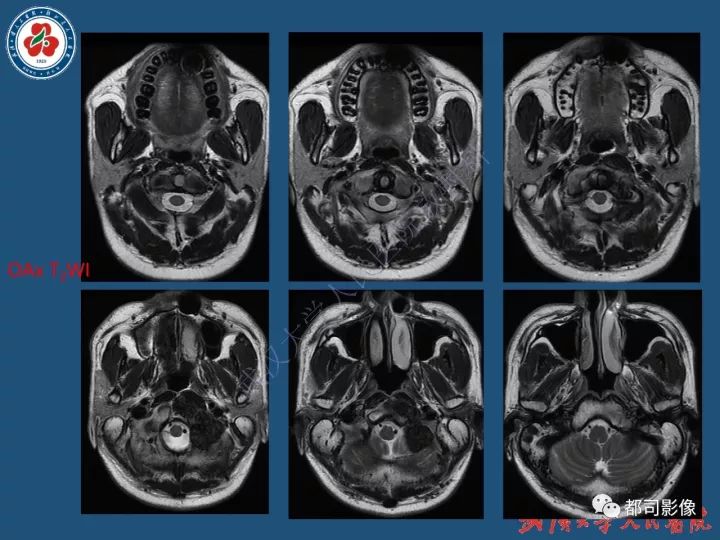 【病例】寰椎及枕骨弥漫性腱鞘巨细胞瘤1例CT及MR影像诊断