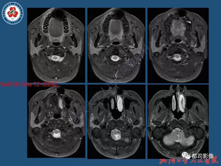 【病例】寰椎及枕骨弥漫性腱鞘巨细胞瘤1例CT及MR影像诊断