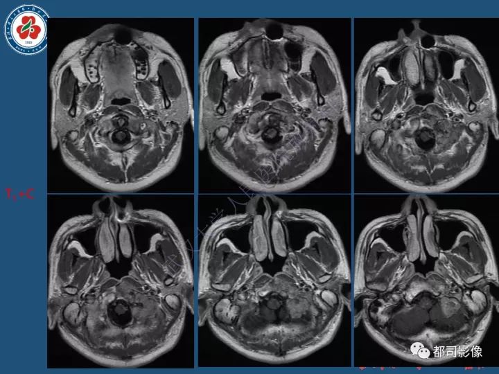 【病例】寰椎及枕骨弥漫性腱鞘巨细胞瘤1例CT及MR影像诊断