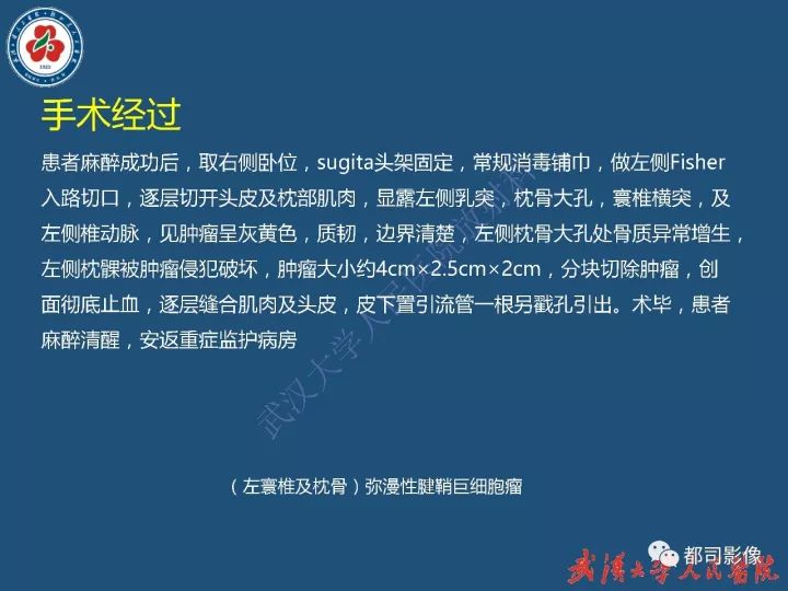 【病例】寰椎及枕骨弥漫性腱鞘巨细胞瘤1例CT及MR影像诊断