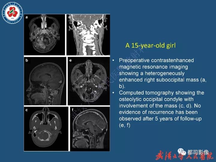【病例】寰椎及枕骨弥漫性腱鞘巨细胞瘤1例CT及MR影像诊断