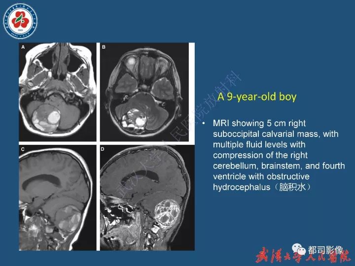 【病例】寰椎及枕骨弥漫性腱鞘巨细胞瘤1例CT及MR影像诊断