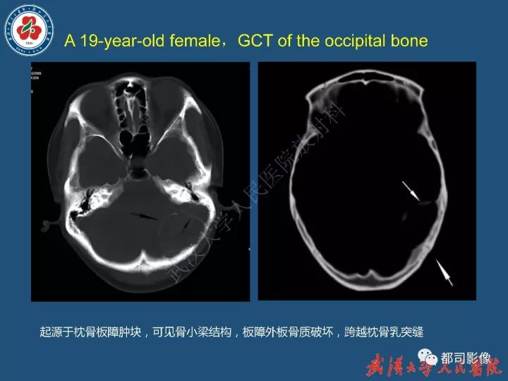 【病例】寰椎及枕骨弥漫性腱鞘巨细胞瘤1例CT及MR影像诊断
