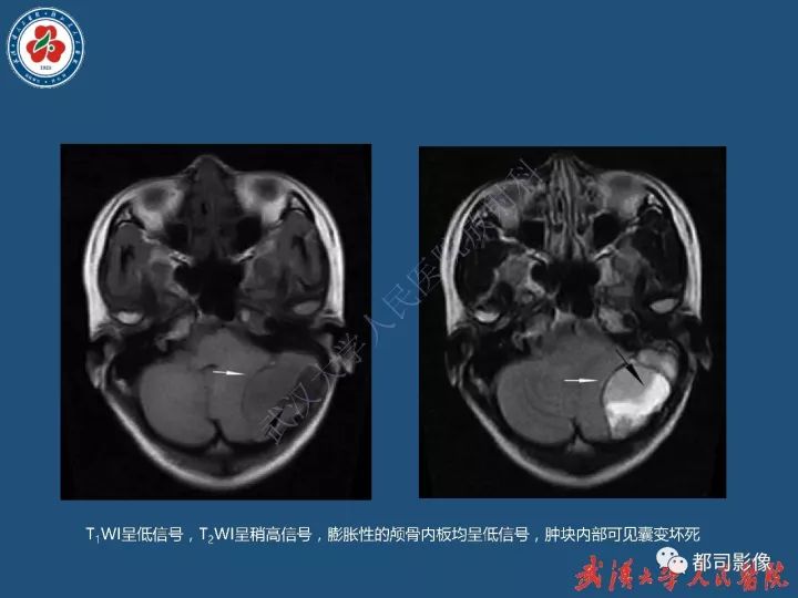 【病例】寰椎及枕骨弥漫性腱鞘巨细胞瘤1例CT及MR影像诊断