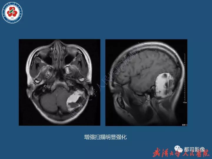 【病例】寰椎及枕骨弥漫性腱鞘巨细胞瘤1例CT及MR影像诊断