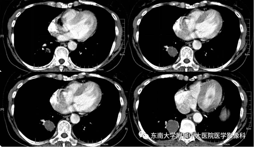 【病例】肺内含液支气管囊肿1例CT影像表现