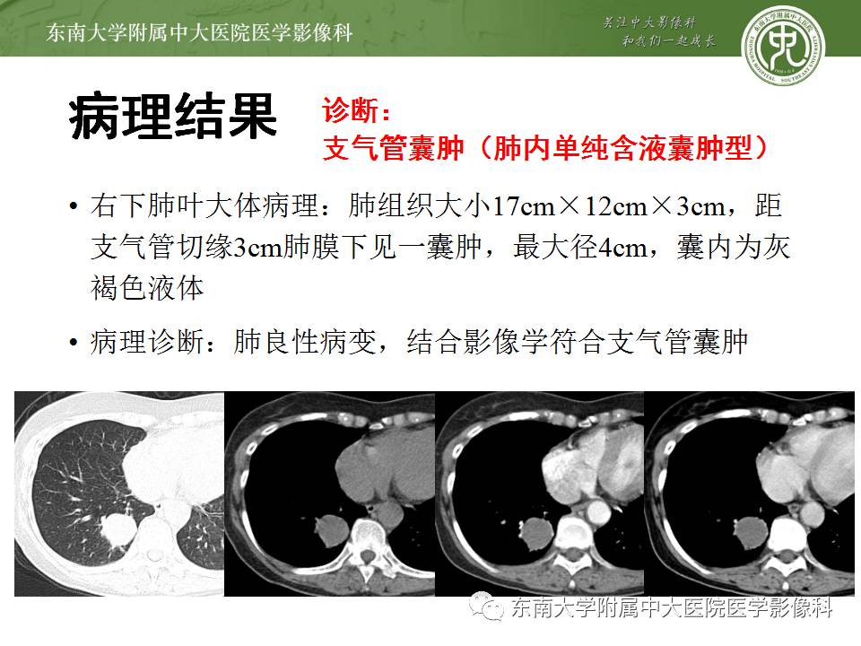 【病例】肺内含液支气管囊肿1例CT影像表现