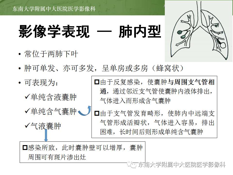【病例】肺内含液支气管囊肿1例CT影像表现