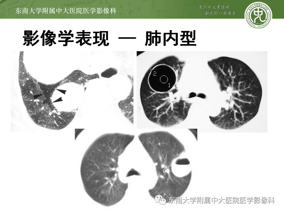【病例】肺内含液支气管囊肿1例CT影像表现