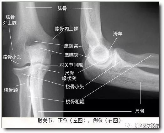 详细的肘关节X线解剖+摄影技巧+骨骺时间+测量方法