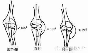 详细的肘关节X线解剖+摄影技巧+骨骺时间+测量方法 详细的肘关节X线解剖+摄影技巧+骨骺时间+测量方法