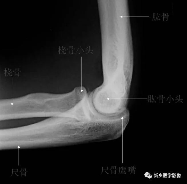 详细的肘关节X线解剖+摄影技巧+骨骺时间+测量方法 详细的肘关节X线解剖+摄影技巧+骨骺时间+测量方法